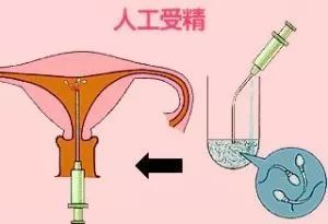 人流手术