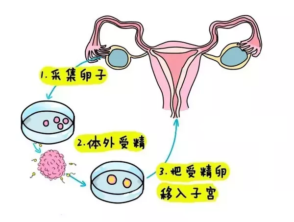 人流手术