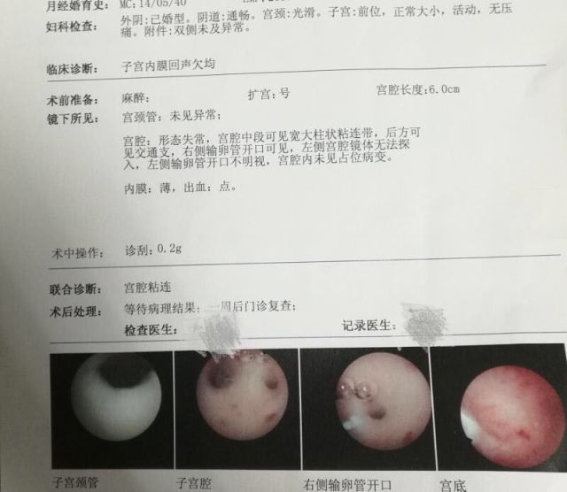 人流手术