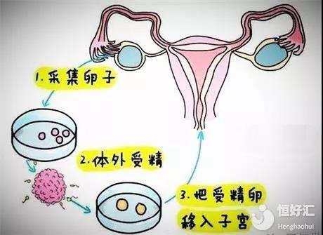 人流手术